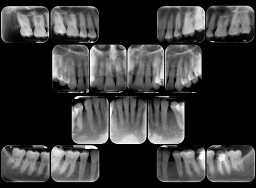 Juego periapical completo