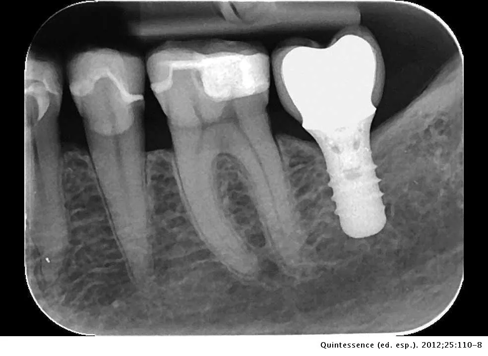 Radiografías intraorales