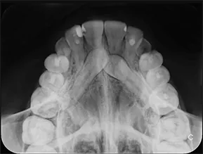 Radiografía oclusal
