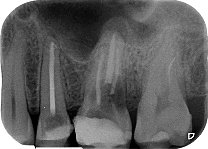 Radiografía periapical